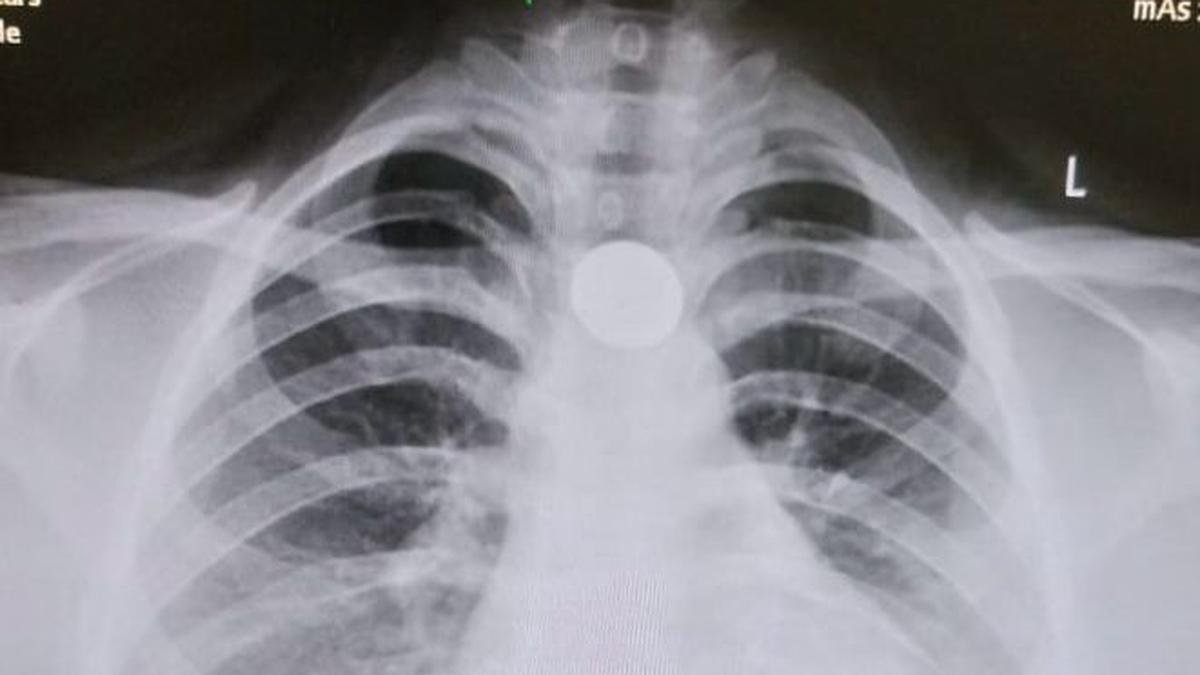 Coins, chemicals and more: doctors urge vigilance amid rise in accidental ingestions among kids during summer vacations Coins, chemicals and more: doctors urge vigilance amid rise in accidental ingestions among kids during summer vacations