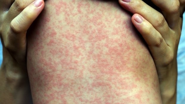 Do I need a third dose of the measles vaccine? And other common questions answered Do I need a third dose of the measles vaccine? And other common questions answered