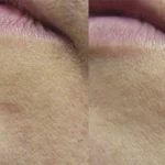 The Truth About Laser Hair Removal: What Melbourne Locals Should Know