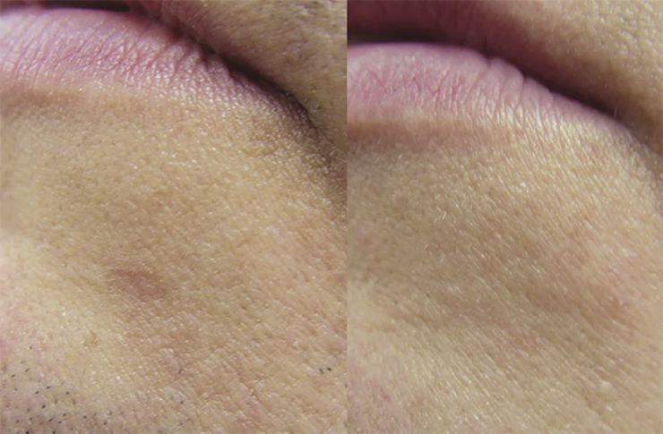 The Truth About Laser Hair Removal: What Melbourne Locals Should Know