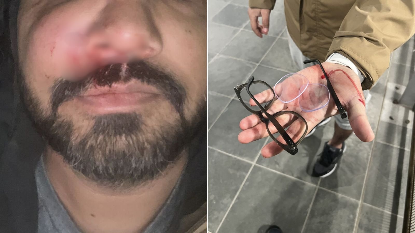 ‘They snatched my glasses, beat me relentlessly’: Indian-origin man shares harrowing details of racist assault in Ireland’s Dublin | World News
